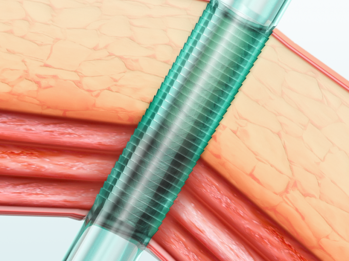 Trocar quang học 5 mm sử dụng một lần, Trocar nội soi loại II và ống thông 0