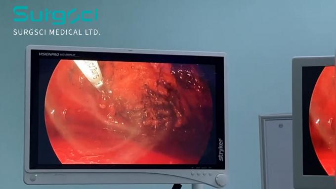 tin tức mới nhất của công ty về Thoát vị: Nguyên nhân, Loại và Lựa chọn Điều trị | phẫu thuật  0