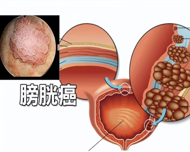 tin tức mới nhất của công ty về Chẩn đoán lâm sàng và chăm sóc sinh lý của ung thư bàng quang.  0